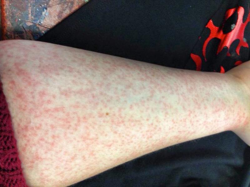This disease makes life painful, but you've probably never heard of it before. Chronic Idiopathic Urticaria is a challenge for many. | Wellness | Medicine | YummyMummyClub.ca