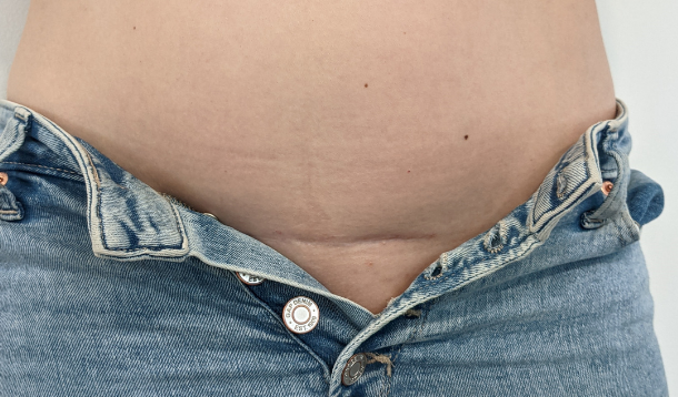 Getting Over The Fear Of My C-section Scar 