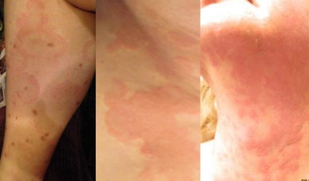 This disease makes life painful, but you've probably never heard of it before. Chronic Idiopathic Urticaria is a challenge for many. | Wellness | Medicine | YummyMummyClub.ca