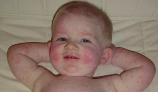 Moms-to-Be: What You Need to Know About Fifth Disease